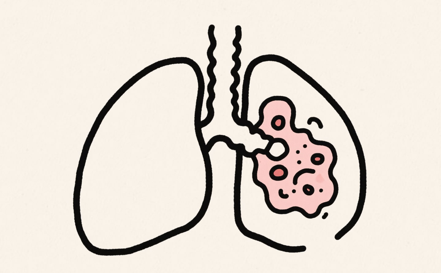 肺癌转移怎么办
